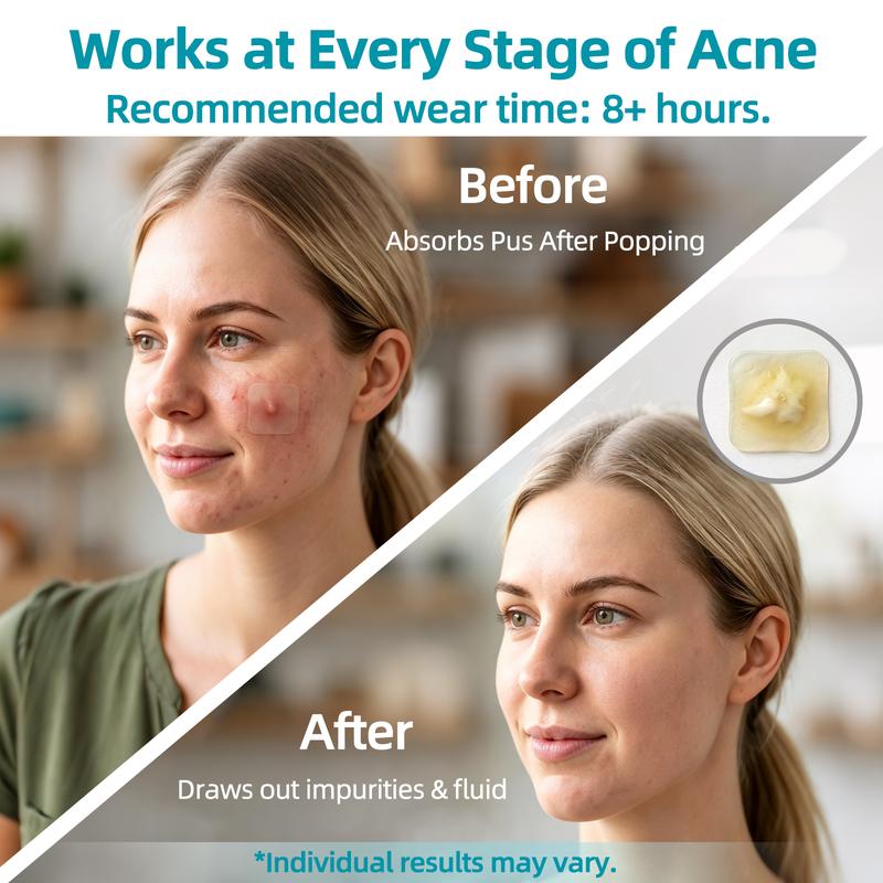 VeyroNova™ | Hydrocolloid Roll